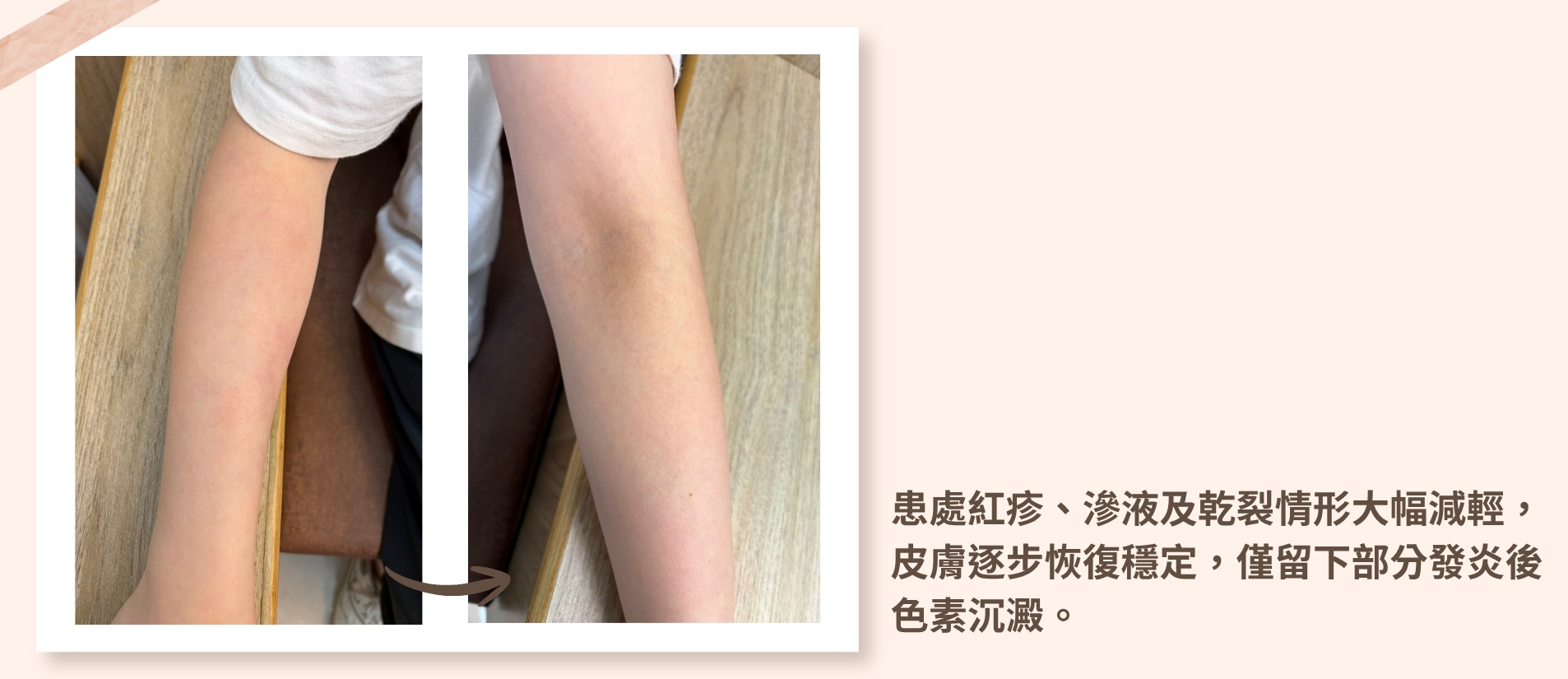 異位性皮膚炎患者經過中醫針灸與中藥調理，夜間搔癢大幅減少，皮膚紅疹、滲液與乾裂情況改善，恢復穩定狀態。