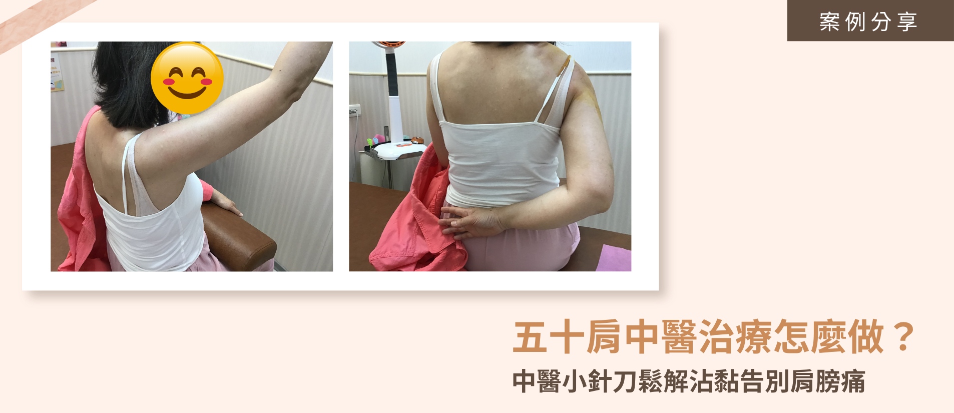 經過中醫規律的小針刀鬆解沾黏與針灸治療，五十肩患者的右肩活動角度明顯改善，手臂已能順暢後伸並摸到後腰。