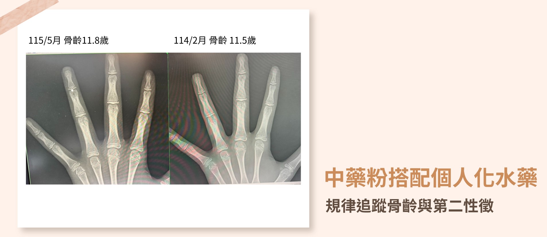 兒童經中醫個人化水藥調理與追蹤後身高平穩成長且骨齡進展恢復穩定