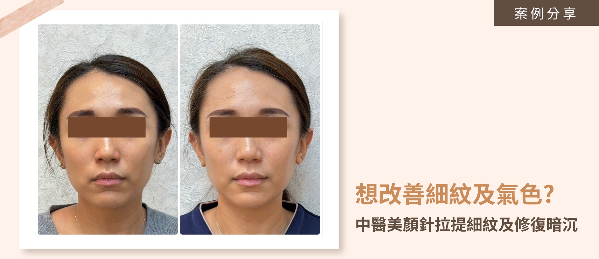 忙碌上班族常因工作壓力與長期熬夜導致睡眠品質不佳，反映在肌膚上便容易出現眼周細紋明顯、膚色暗沉不均以及上妝容易卡粉脫妝等困擾。