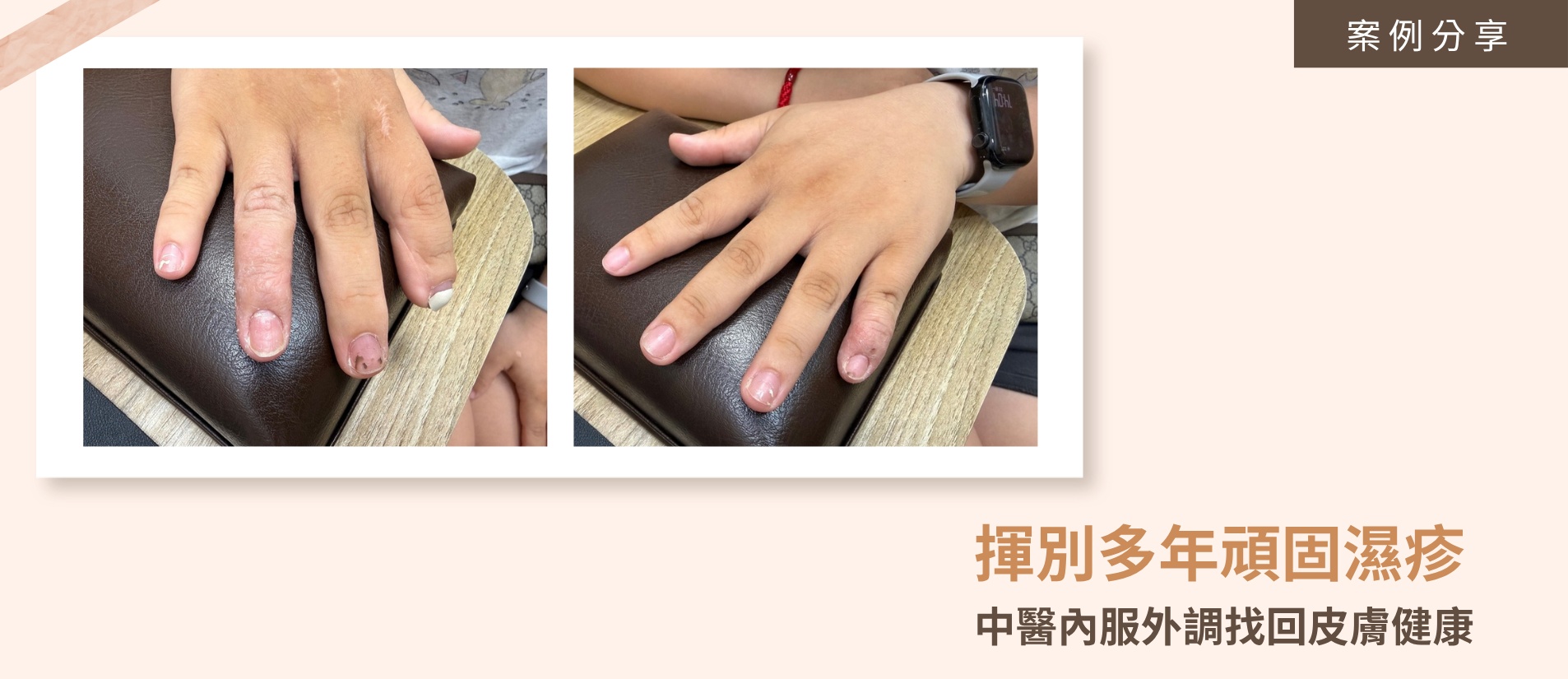 中醫師建議的濕疹日常保養與飲食指南，包含勤擦無香精保濕乳液、多攝取降發炎的地中海飲食與好油，從內而外滋陰潤膚。