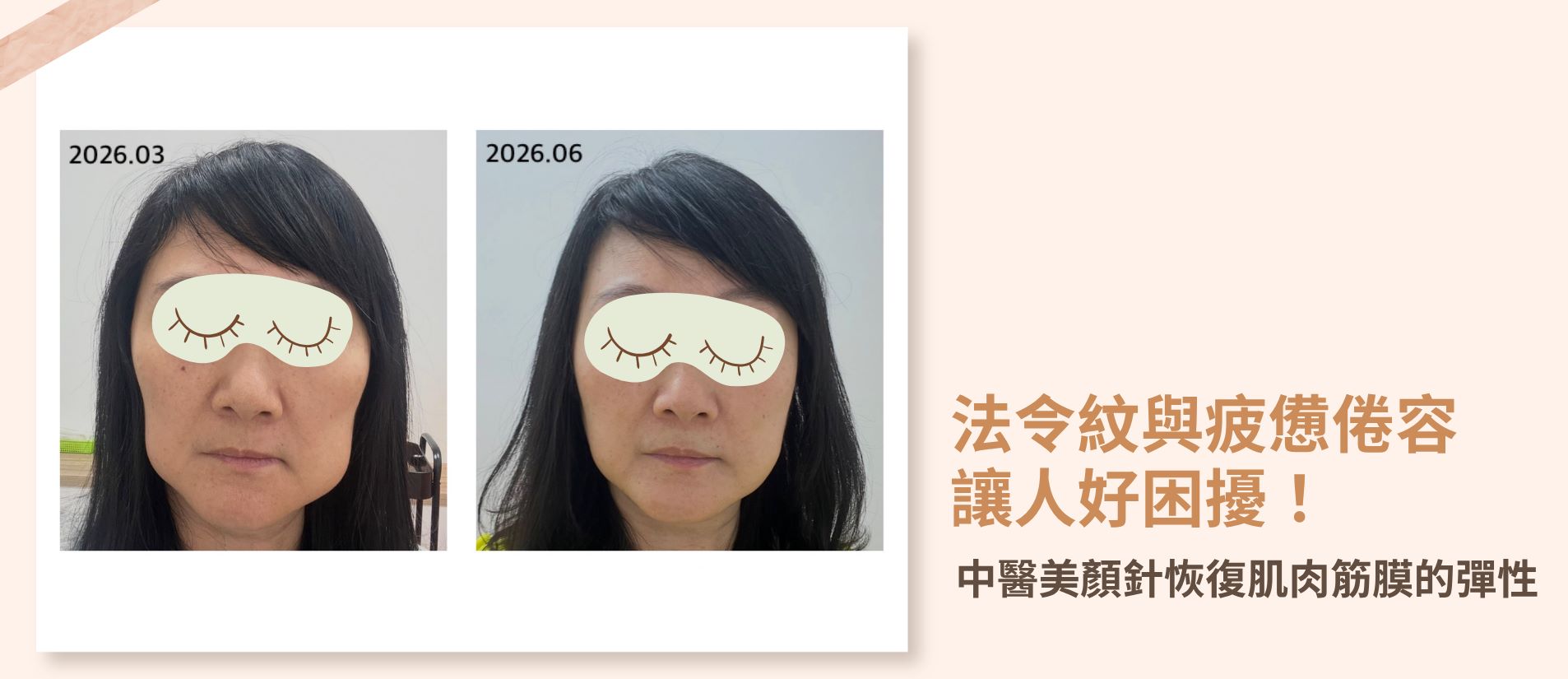 中醫美顏針調理後面部線條平順緊緻且整體氣色明顯提升