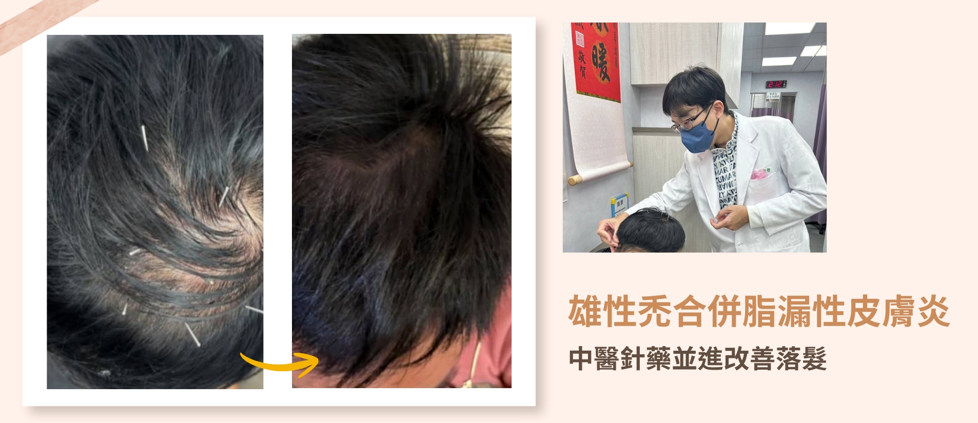 雄性禿患者經中醫疏肝降火與每週頭皮針灸治療三個月後，不僅落髮減少、長出濃密新髮，連睡眠品質與臉部痘痘都大幅改善。