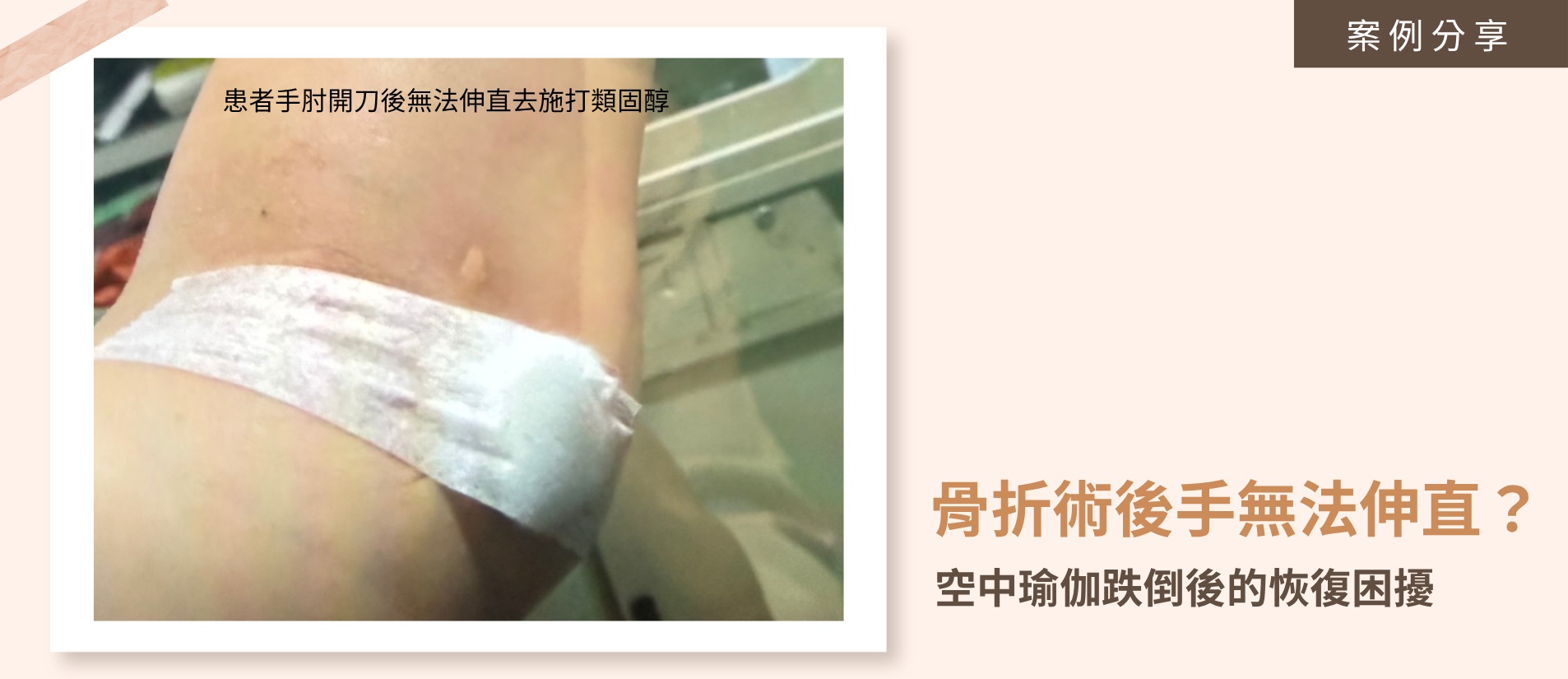 骨折術後若缺乏妥善復健，容易遺留肌肉緊繃與關節僵硬的後遺症。