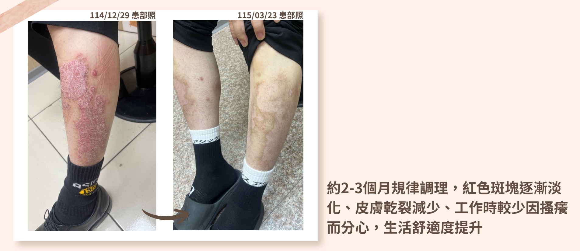 透過專業中藥水藥調理與生活習慣調整，幫助改善皮膚紅腫脫屑與搔癢困擾，重獲平滑健康肌膚！