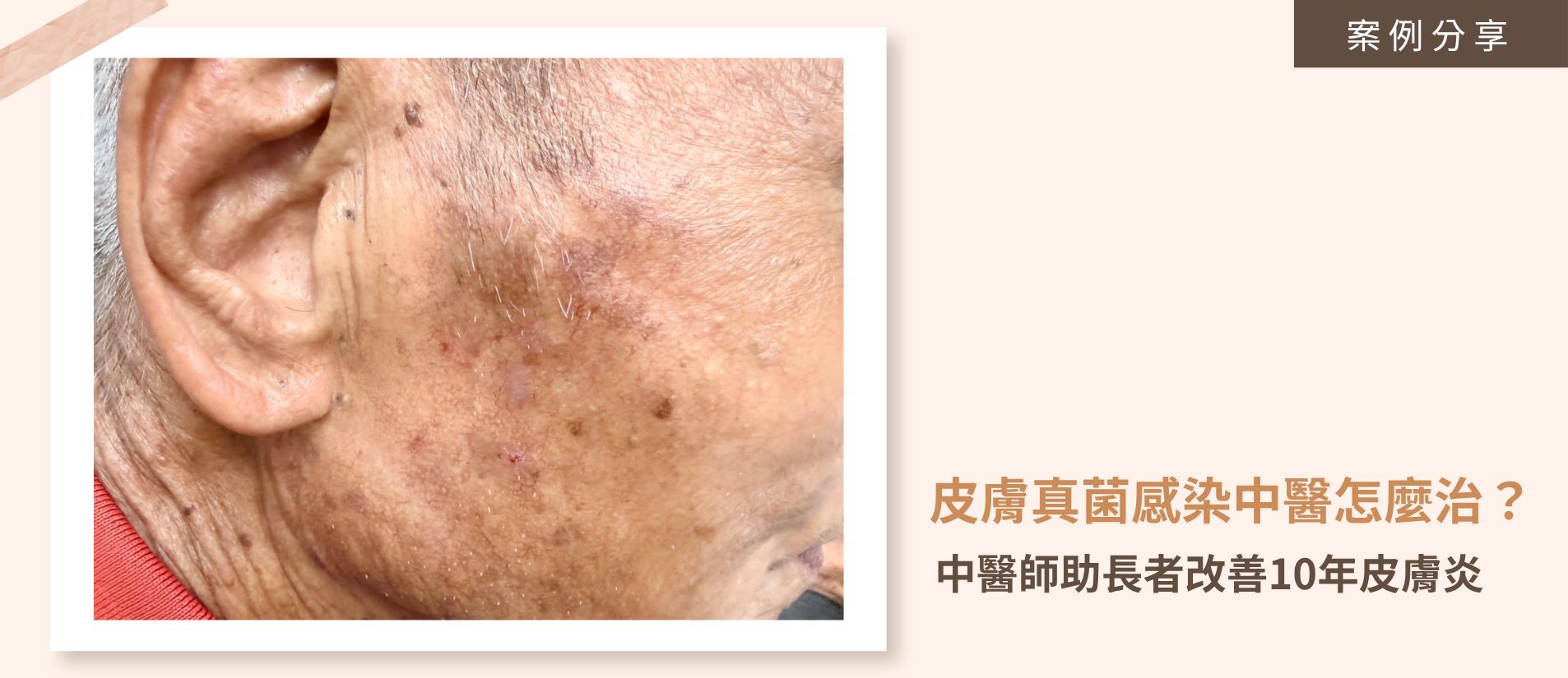 中醫內服外敷調理三個月後，長者真菌皮膚炎改善八成，皮膚恢復平滑乾淨